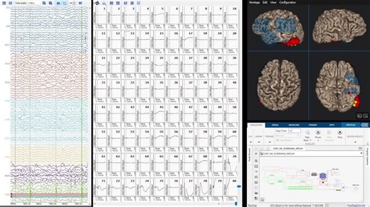 CCEP mapping of the whole cortex in 60 min. 😇 The yellow electrode pairs are automatically selected and provide electrical current stimulation of the corresponding cortical region in order to… | g.tec medical engineering GmbH - NEVER STOP RECORDING
