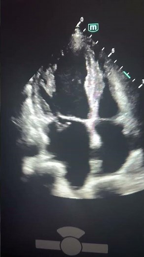 Mitral valve flail #echocardiography #science #echocardiographer