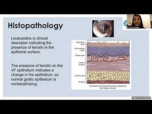 Vocal fold leukoplakia management - Dr. Sara Abu-Ghanem