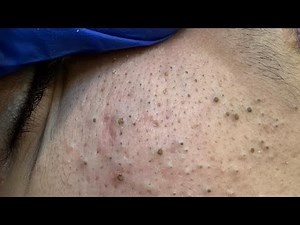 Deep Pore Cleansing Facial | Blackhead & Whitehead Removal (Skin Purification)