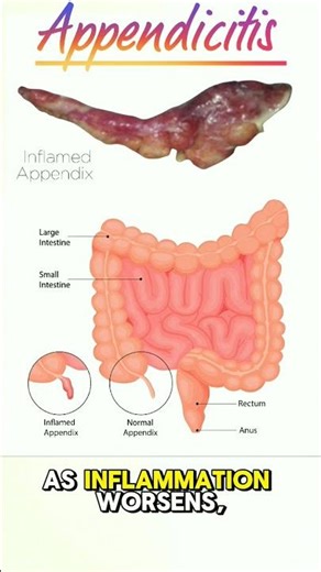 Appendicitis #anatomy #biology #doctor #humanbody #disease #surgery