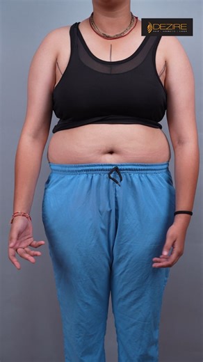 Dr Prashant Yadav on Instagram: "Double Incision FTM Top Surgery planning before surgery Book your free consultation with Dr. Prashant Yadav today At Dezire Clinic Call us on : Delhi - 8956880644 | Pune - 7276606484 | Bangalore- 8971224700 Gurugram - 9272007896 | Ahmedabad - 9711162746 #FTMTopSurgery #DoubleIncision #surgerymarking #GenderAffirmingCare #femaletomalesurgery #TransHealth #TopSurgeryJourney #TransFormation"