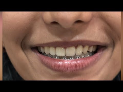 Braces Removed? Now What? Retainers Explained..