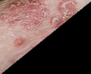 Certificate and Diploma program in General Dermatology