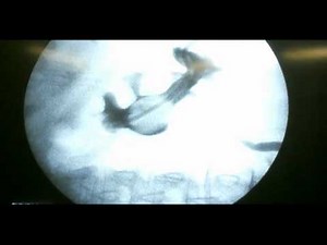 APG, Antegrade pyelografi