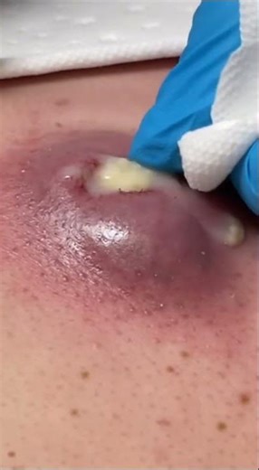 Extreme Pimple Popping & Dermatology Extractions | The Ultimate Satisfying Content() #short #acne