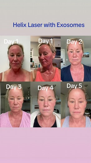 Helix Fusion of Co2 and fractional laser for skin reaurfacing and tightening. Exosomes along with good skin care helps expedite healing. Still a little swillen and red at beginning of fay 5 but loving results. This was Medium in how aggressive procedure was done. #ocinjector #newport injector #newportfiller # #newportinjectables #newportbeachinjectables #newportbeachfillers #ocinjectables #newportbotox #newportbeachfiller #newportbeachinjector #botox #botoxinjections #botoxcomestics #aestheticme