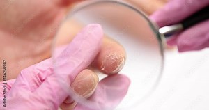 Dry hands and peeling skin and mycosis