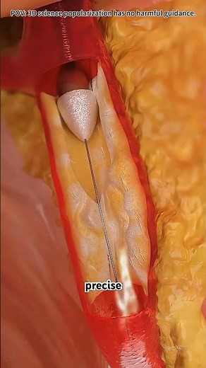 How rotational atherectomy is done? #drone #theflash #space