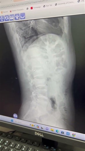 A Broken Spine Caught on X-Ray #chiropractic #diagnosis #backpain #pregnant #doctor