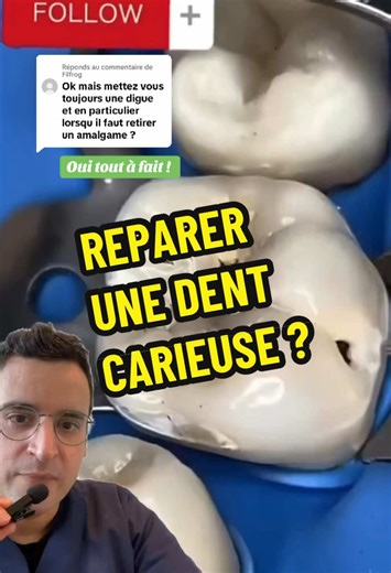 Réponse à @Filfrog Réparation molaire au composite : la carie n’a aucune chance ! 🦷 😇 On se demande parfois : « Comment être sûr d’enlever toute la carie dans une molaire avant de poser le composite ? Y a-t-il un moyen de repérer les zones infectées ? » Le révélateur de carie, une solution colorante, aide à distinguer la dent saine de la dent cariée. Il permet de garantir un nettoyage précis et d’optimiser la restauration en composite. Pourquoi utiliser un révélateur de carie \t•\t🤔 Sécurité