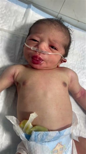 Newborn Baby Fighting RDS in NICU – Brave Little Fighter 💔👶