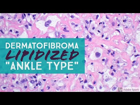 Dermatofibroma, Lipidized ("Ankle Type")...Explained by a Dermatopathologist
