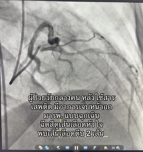 ผลกระทบจากสารเสพติดต่อสุขภาพหัวใจ