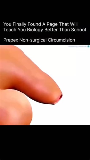 Explaining The Humans on Instagram: "PrePex is a non-surgical, bloodless circumcision method designed to be quick, safe, and anesthesia-free. It uses a medical-grade elastic ring that gently cuts off blood supply to the foreskin. Over a few days, the foreskin dries and is removed without cutting or stitches. DM for credit/removal #PrePex #NonSurgicalCircumcision #MedicalScience #HealthEducation #fypシ❤️💞❤️"