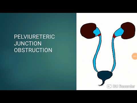 PUJO -Pelviureteric junction obstruction (Pediatric Surgery)
