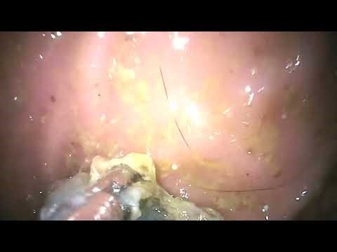 Endoscopy foreign body removal cat