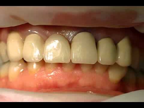 What are Temporary Dentures