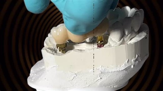 Such a satisfying moment. #smartdentureconversions #realtimedentallab #caryprosthdontics #smartonX | David Hsieh