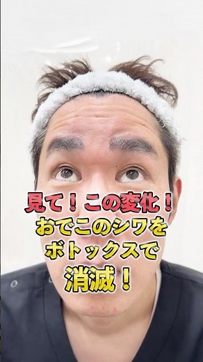 【おでこの横じわ消しませんか？】鏡を見るのが楽しくなる！おでこボトックスの4週間後のリアルな経過を公開