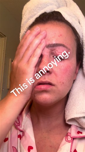 I’m 27 and I have the worst skin I’ve ever had in my life. I don’t get it. My mom has literally never taken care of her skin or do anything to help it and it’s GLASSSSSSSS!!! Like you couldn’t even pass that down dude? #skincare #breakout #acne #mixoon #stress