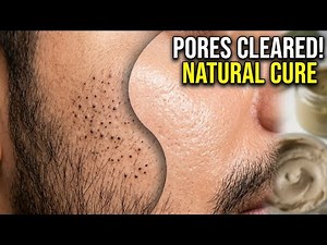Deep Pore Cleansing For Blackheads/ Natural Remedies For Old Aged Blackheads