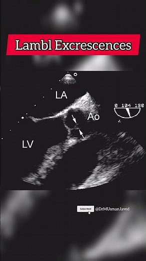 Lambl excrescences #heart #Echocardiogram #aorticvalve
