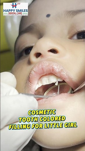 Tooth-Colored Cavity Filling for Little Girl | Happy Smiles Dental Care
