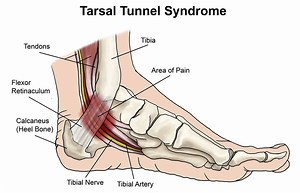 Tarsal tunnel syndrome symptoms, causes, diagnosis, prognosis & treatment