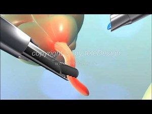 V 049 Wurmfortsatz Blinddarm OP - PAL 16:9 / V 049 appendix - PAL 16:9