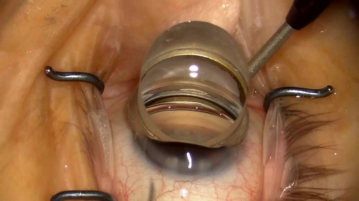 Improving Surgical Gonio View - Eyetube