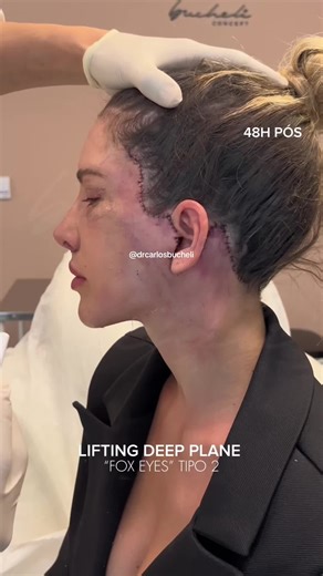 Transformación Facial: Lifting Profundo por Dr. Carlos Bucheli