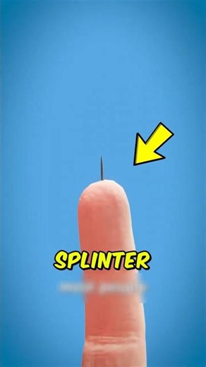 Don't Pull Out a Splinter Until You See This! 😱 The Easy Removal Trick