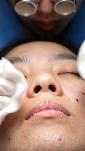 👂✨ Watch Stubborn Ear Blackheads Get Carefully Removed for a Clean, Satisfying Transformation!