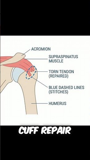 Inside Your Joint: The 3 Most Common Shoulder Surgeries Explained!