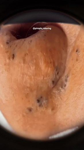 So many 😳 #blackheads #supersatisfying #extractionsatisfaciton #pimplepop