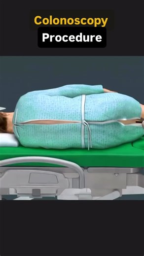 Colonoscopy Procedure Incredible educational video by @dimacourse1 - They are a definite must follow on Instagram and YouTube! 🔎 This is a life-saving procedure! Colonoscopy is recommended for adults starting at age 45 to screen for colorectal cancer and detect early polyps, which can prevent cancer. Those with higher risk factors, such as a family history of colorectal cancer or certain genetic conditions, may need to start screening earlier and repeat tests more frequently. If the initial scr