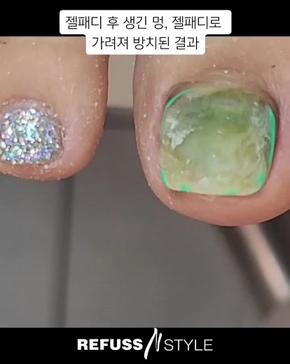 젤패디 부작용? 피멍으로 인한 녹농균 발톱 관리