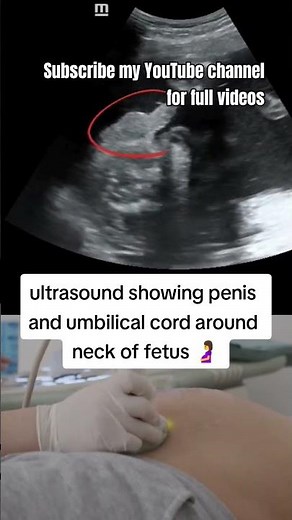 Ultrasound showing penis and umbilical cord around neck of Fetus|baby|