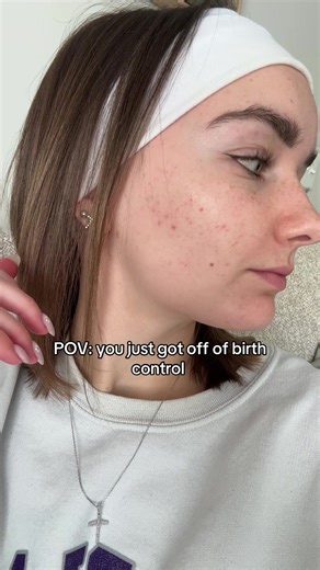 Birth Control Acne: Causes & Solutions