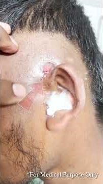 মাওলানা সাহেব কানের যে বিরল রোগটিতে ভুগছেন | Preauricular sinus | Dr. Mahmud Asif Rifat