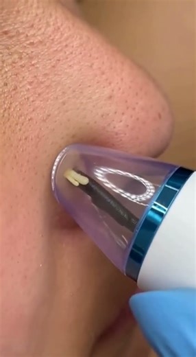 I Tried The Most Expensive Blackhead Removal Tool... Was It Worth It?