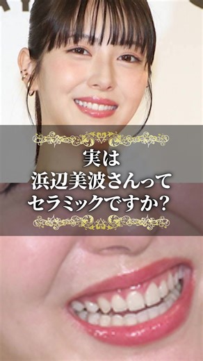 浜辺美波さんのセラミック矯正の魅力