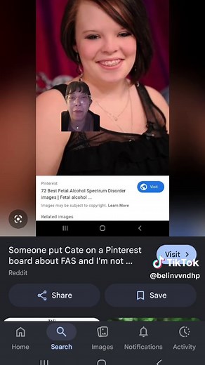 I was scrolling Google images and i looked up images of people with fetal alcohol syndrome (FAS) because I heard it mentioned that they have certain facial characteristics that a person who doesn't have FAS. Catelynn Baltierra from team mom popped up and she was on a Pinterest list for 72 best fetal alcohol syndrome disorder images. I thought that was odd. was someone trying ro be funny? or does she suffer from FAS? #teenmomog #teenmom #mtv #fas #realityshow