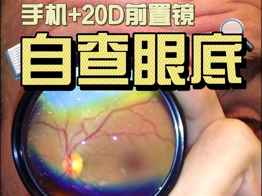 【中英丨自查眼底】使用20D前置镜 手机摄像头进行眼底自查（需散瞳）