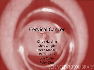 Cervical Cancer - SlideServe