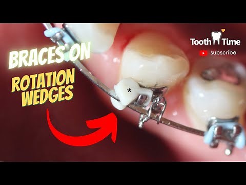 Rotation Wedges in Orthodontics - Braces Checkups - Tooth Time Family Dentistry New Braunfels