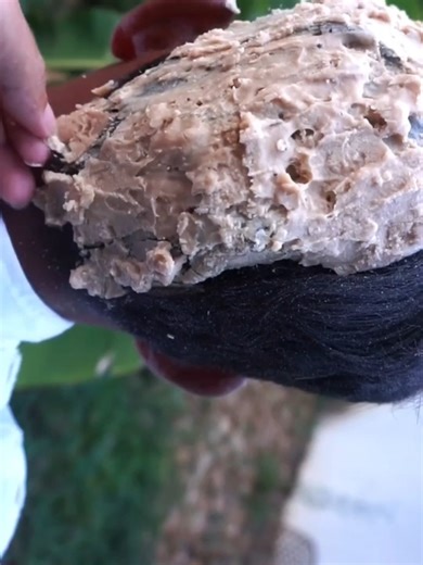 Dandruff satisfying removal #DandruffScratching #ItchyDryScalp #HugeFlakes #Dandruff #dandrufftreatment #satisfying #dandruffremoval #fblifestyle Disclaimer: Videos do not show original Dandruff,they are used for education purpose. Thank You,,, | Hit's