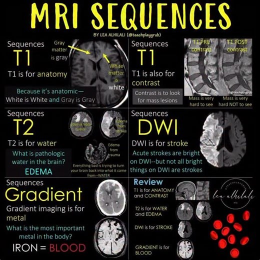 Lea Alhilali, MD | If you aren’t cheating, you aren’t trying! Are you looking at MRIs? Feeling some confusion about the diffusion? Feel impaired when it... | Instagram