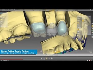 inLab SW: Faster Pontic Bridge Design